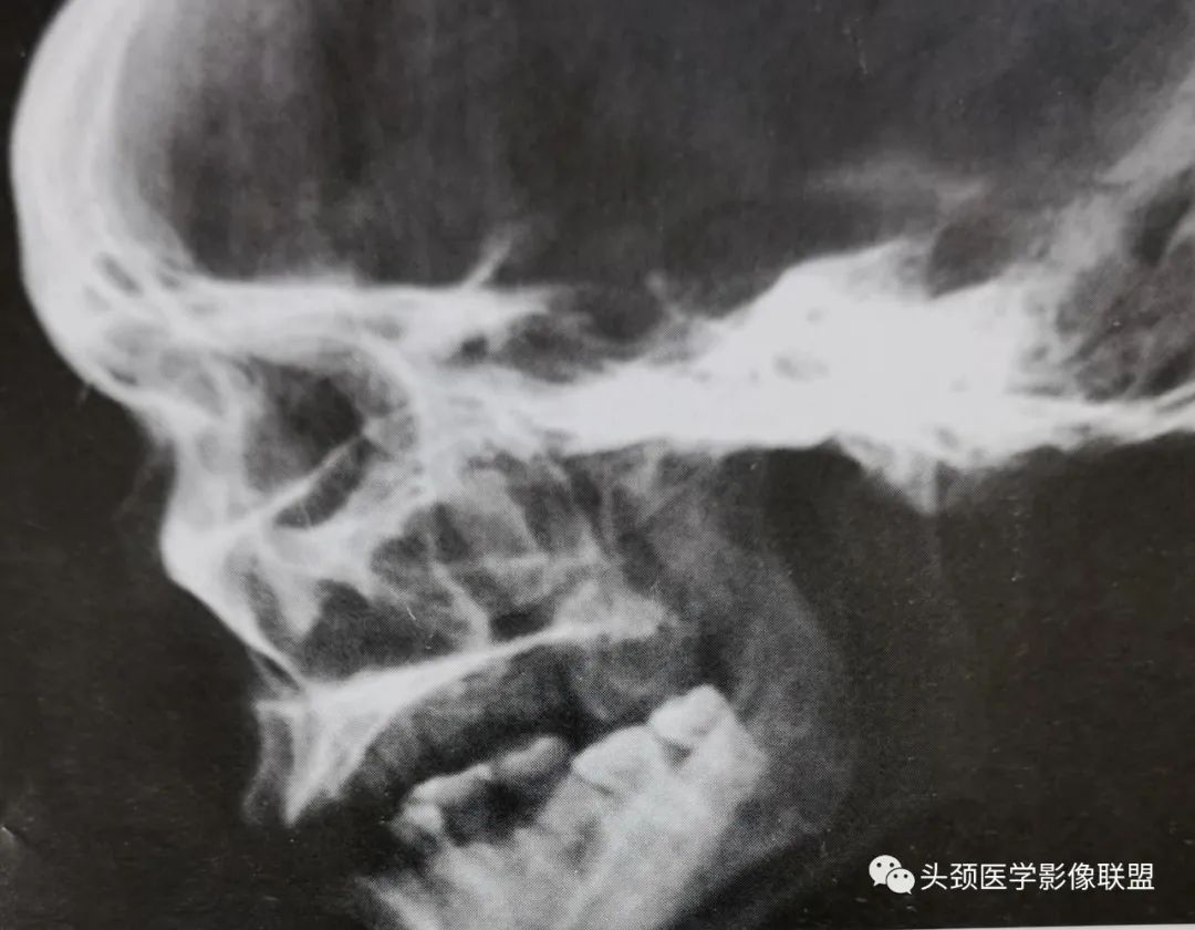 影像PPT - 眼眶解剖（X线/CT/MRI）和常见变异及误判-6