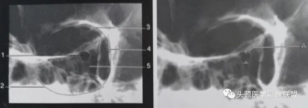 影像PPT - 眼眶解剖（X线/CT/MRI）和常见变异及误判-7