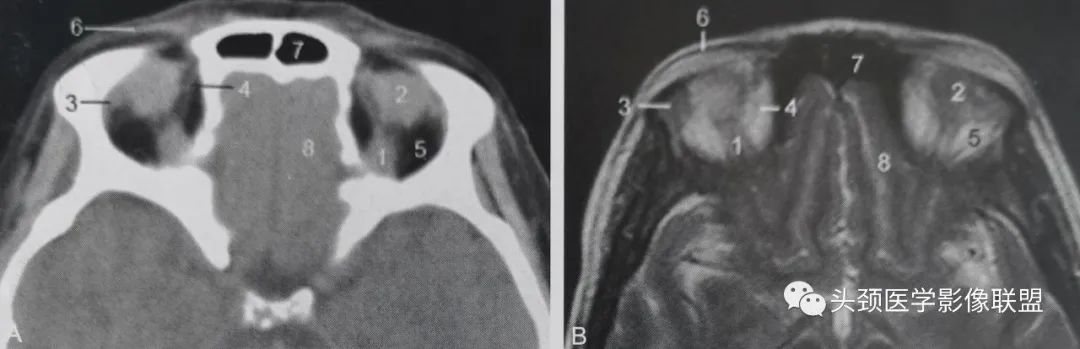 影像PPT - 眼眶解剖（X线/CT/MRI）和常见变异及误判-9