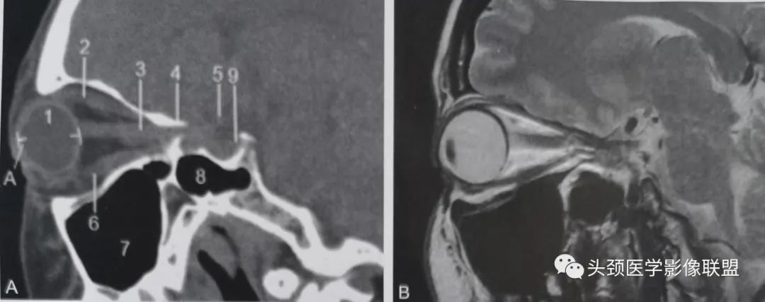 影像PPT - 眼眶解剖（X线/CT/MRI）和常见变异及误判-13