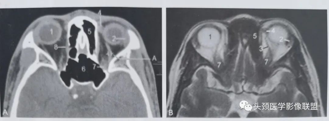 影像PPT - 眼眶解剖（X线/CT/MRI）和常见变异及误判-10