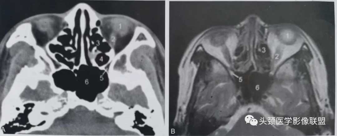 影像PPT - 眼眶解剖（X线/CT/MRI）和常见变异及误判-12