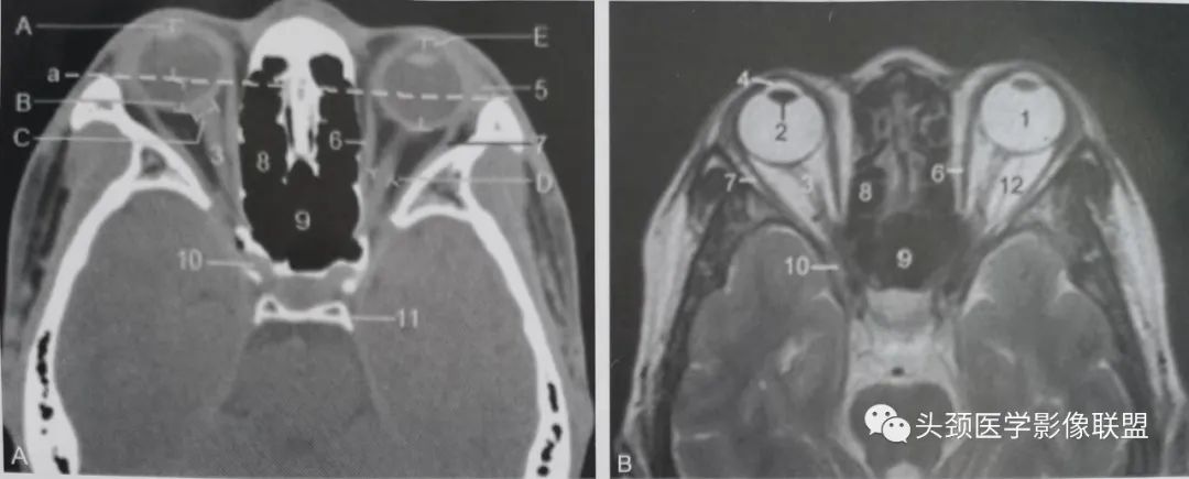 影像PPT - 眼眶解剖（X线/CT/MRI）和常见变异及误判-11