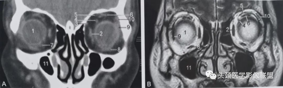 影像PPT - 眼眶解剖（X线/CT/MRI）和常见变异及误判-14