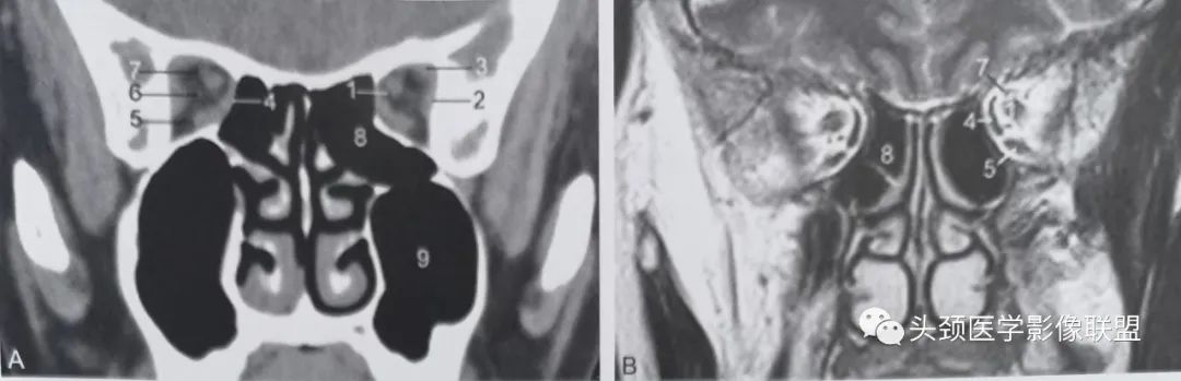 影像PPT - 眼眶解剖（X线/CT/MRI）和常见变异及误判-16