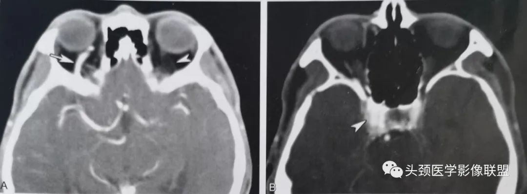 影像PPT - 眼眶解剖（X线/CT/MRI）和常见变异及误判-18