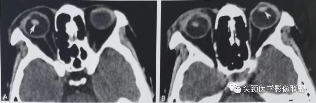 影像PPT - 眼眶解剖（X线/CT/MRI）和常见变异及误判-17