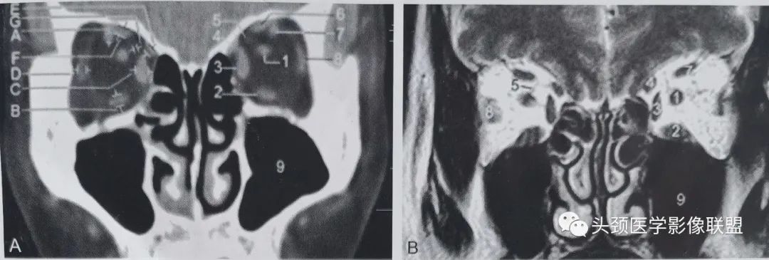 影像PPT - 眼眶解剖（X线/CT/MRI）和常见变异及误判-15