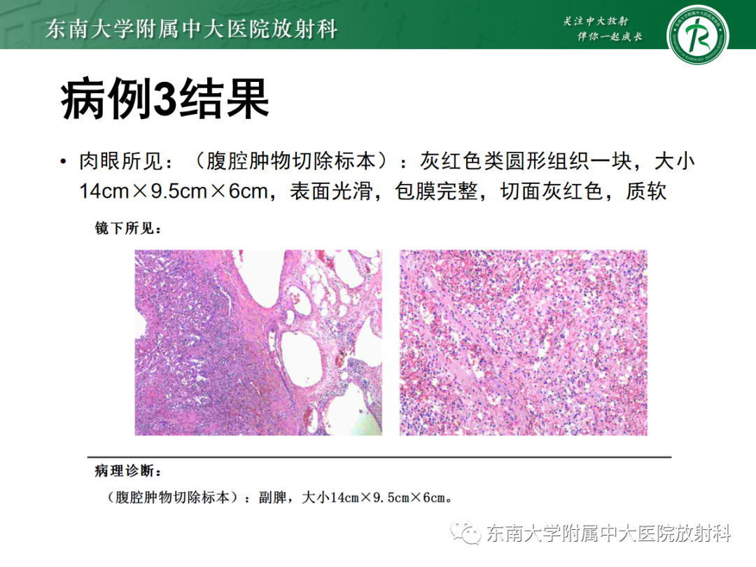 影像PPT - 【PPT】腹部孤立性实性占位病例随访-13 影像PPT - 【PPT】腹部孤立性实性占位病例随访-13