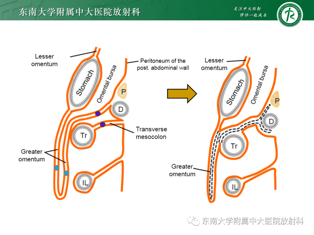 影像PPT - 【PPT】腹部孤立性实性占位病例随访-18 影像PPT - 【PPT】腹部孤立性实性占位病例随访-18