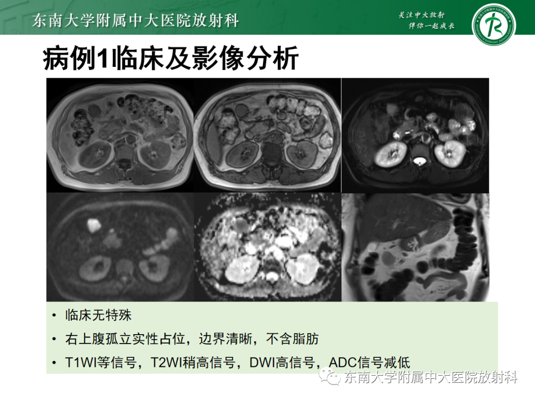 影像PPT - 【PPT】腹部孤立性实性占位病例随访-24 影像PPT - 【PPT】腹部孤立性实性占位病例随访-24