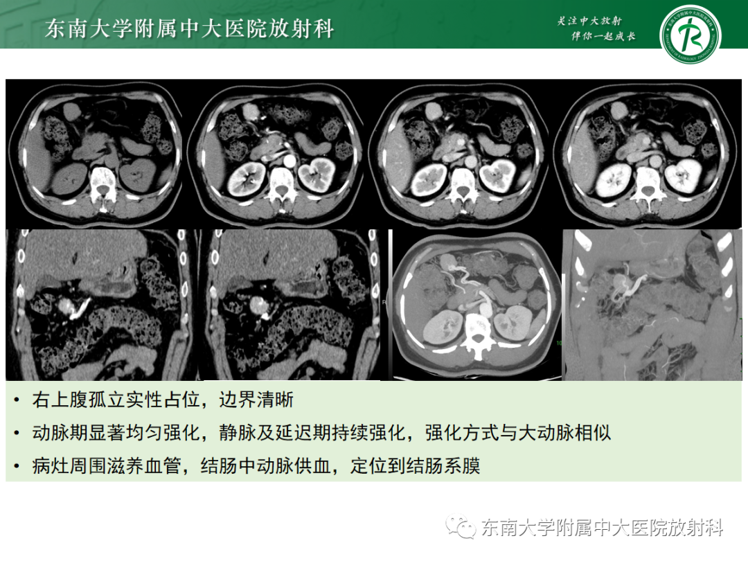 影像PPT - 【PPT】腹部孤立性实性占位病例随访-25 影像PPT - 【PPT】腹部孤立性实性占位病例随访-25