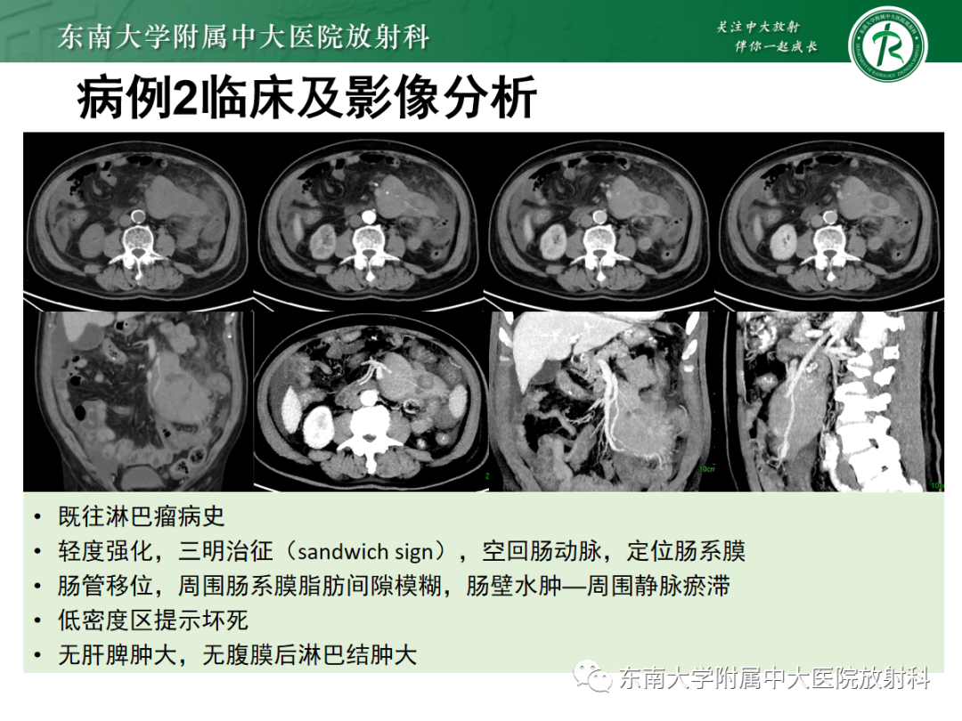 影像PPT - 【PPT】腹部孤立性实性占位病例随访-34 影像PPT - 【PPT】腹部孤立性实性占位病例随访-34
