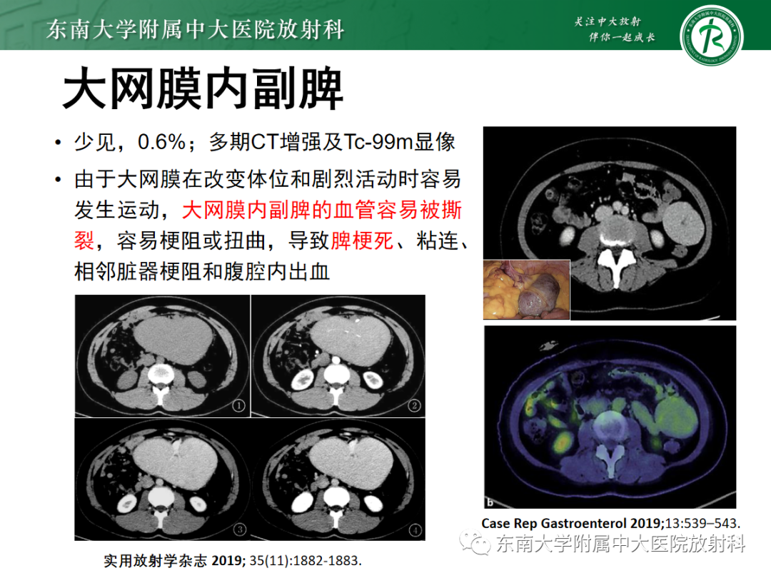 影像PPT - 【PPT】腹部孤立性实性占位病例随访-41 影像PPT - 【PPT】腹部孤立性实性占位病例随访-41