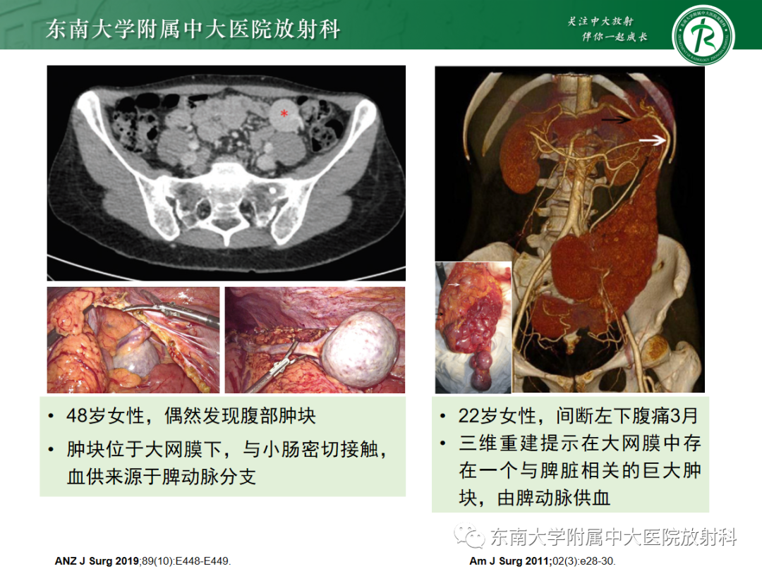 影像PPT - 【PPT】腹部孤立性实性占位病例随访-42 影像PPT - 【PPT】腹部孤立性实性占位病例随访-42