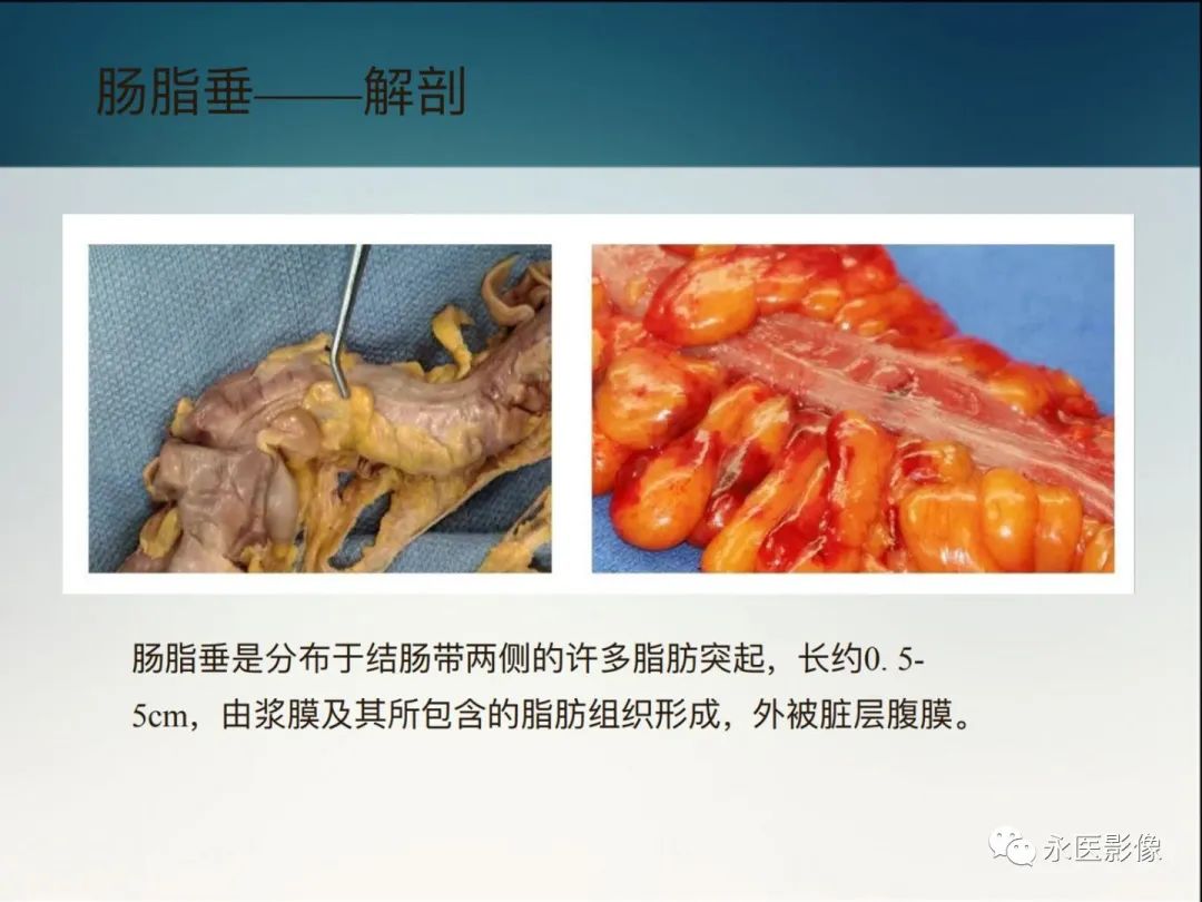 影像PPT - 【PPT】急性原发性肠脂垂炎的CT诊断及鉴别诊断-3