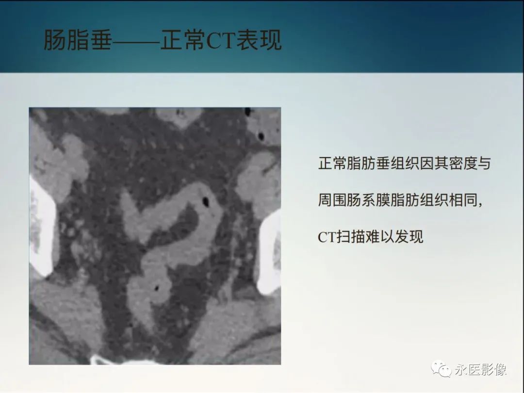 影像PPT - 【PPT】急性原发性肠脂垂炎的CT诊断及鉴别诊断-6
