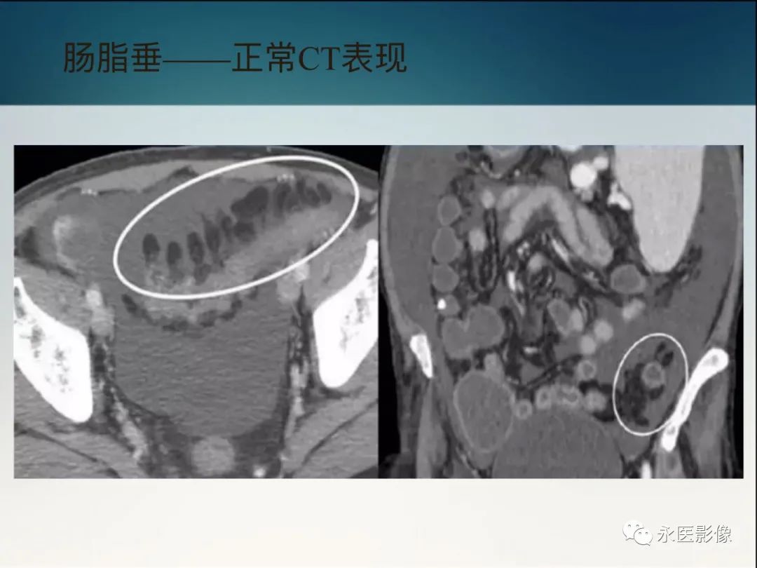 影像PPT - 【PPT】急性原发性肠脂垂炎的CT诊断及鉴别诊断-8