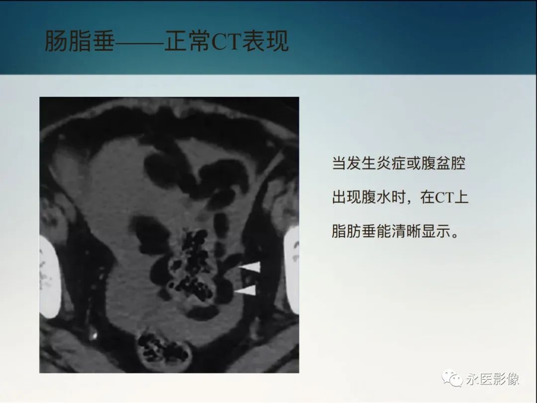 影像PPT - 【PPT】急性原发性肠脂垂炎的CT诊断及鉴别诊断-7