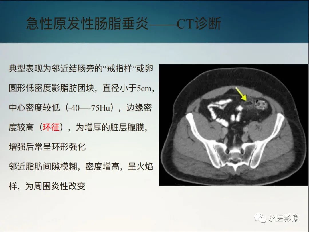 影像PPT - 【PPT】急性原发性肠脂垂炎的CT诊断及鉴别诊断-13