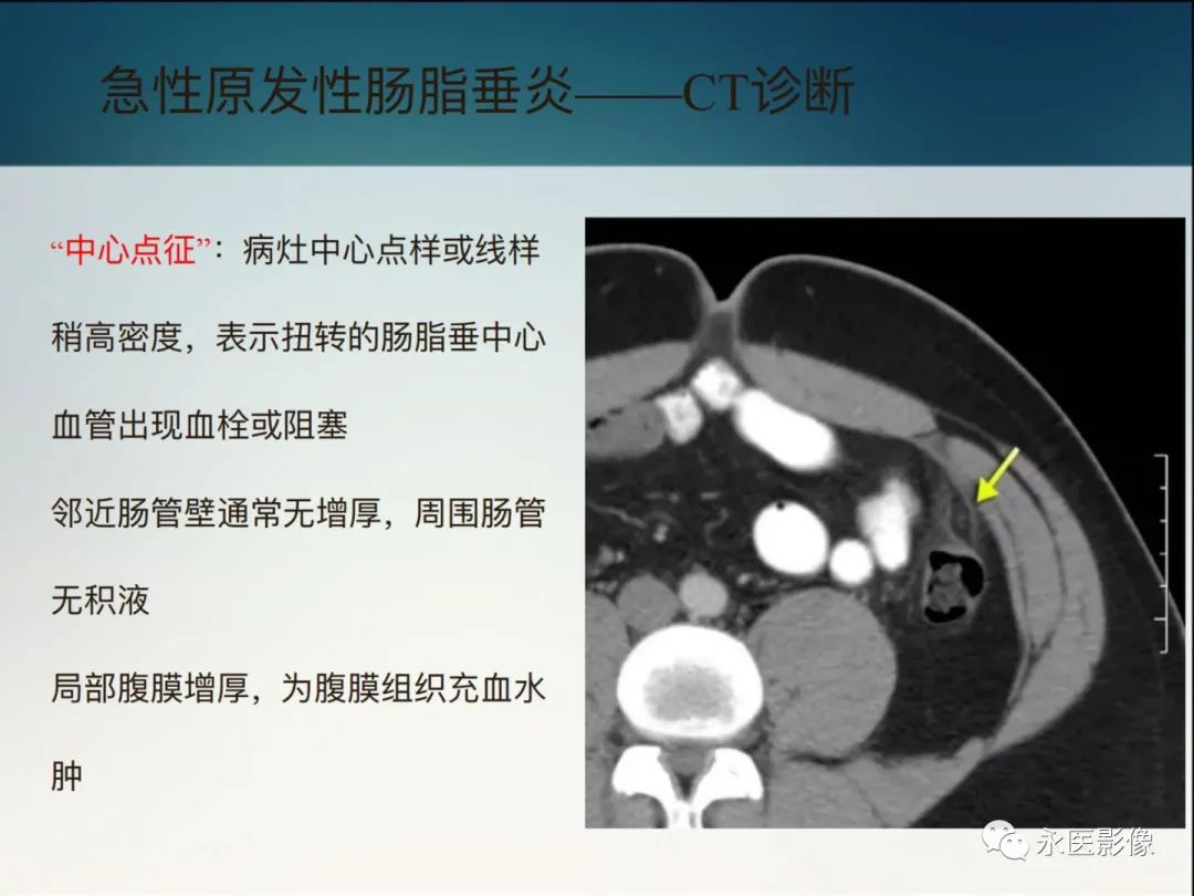 影像PPT - 【PPT】急性原发性肠脂垂炎的CT诊断及鉴别诊断-14