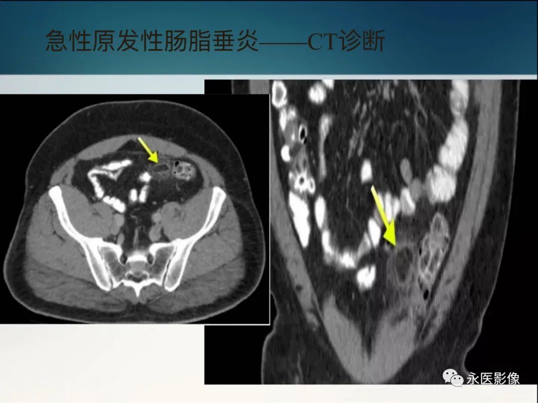 影像PPT - 【PPT】急性原发性肠脂垂炎的CT诊断及鉴别诊断-15