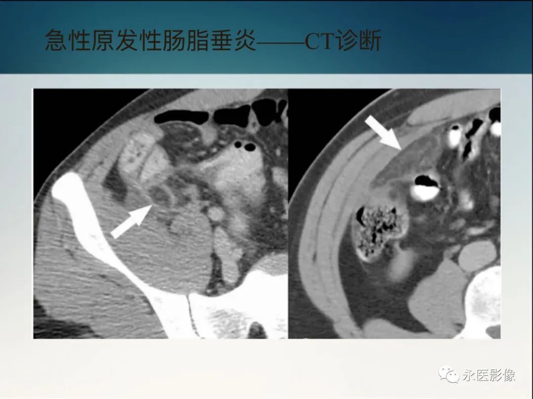 影像PPT - 【PPT】急性原发性肠脂垂炎的CT诊断及鉴别诊断-16