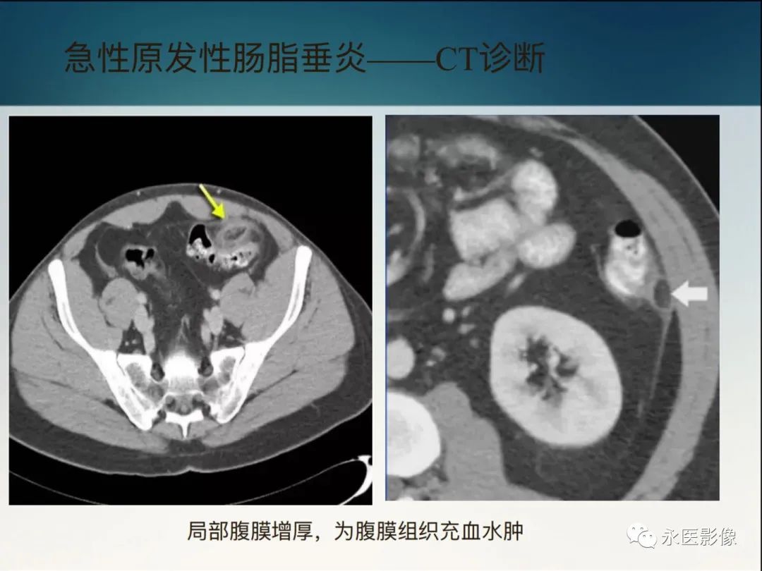 影像PPT - 【PPT】急性原发性肠脂垂炎的CT诊断及鉴别诊断-17