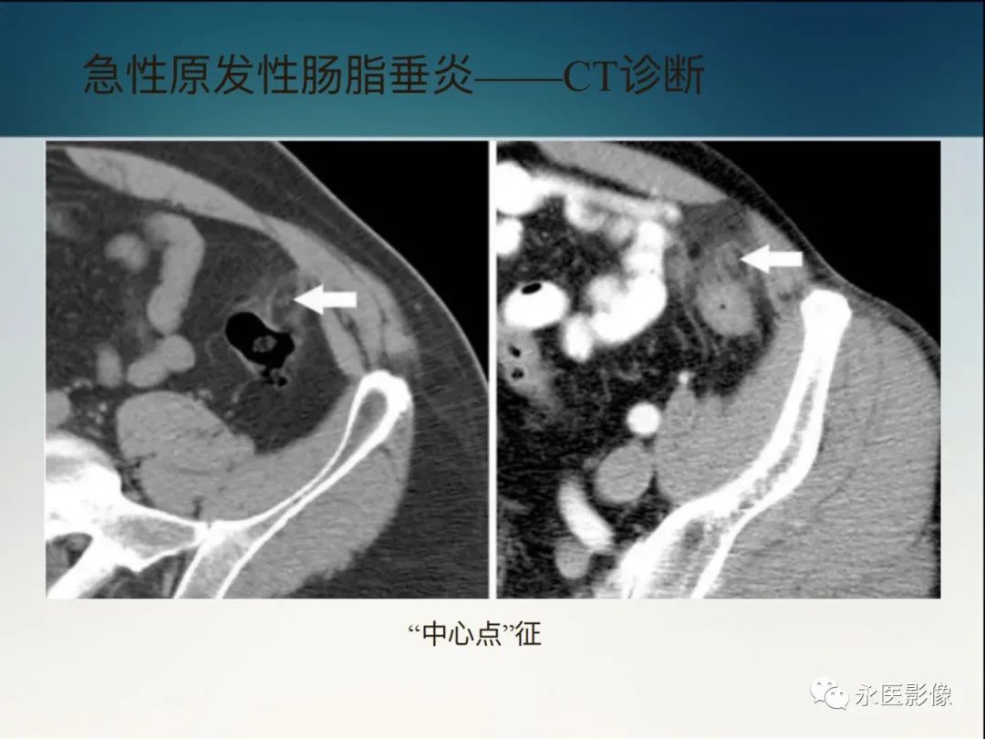 影像PPT - 【PPT】急性原发性肠脂垂炎的CT诊断及鉴别诊断-18