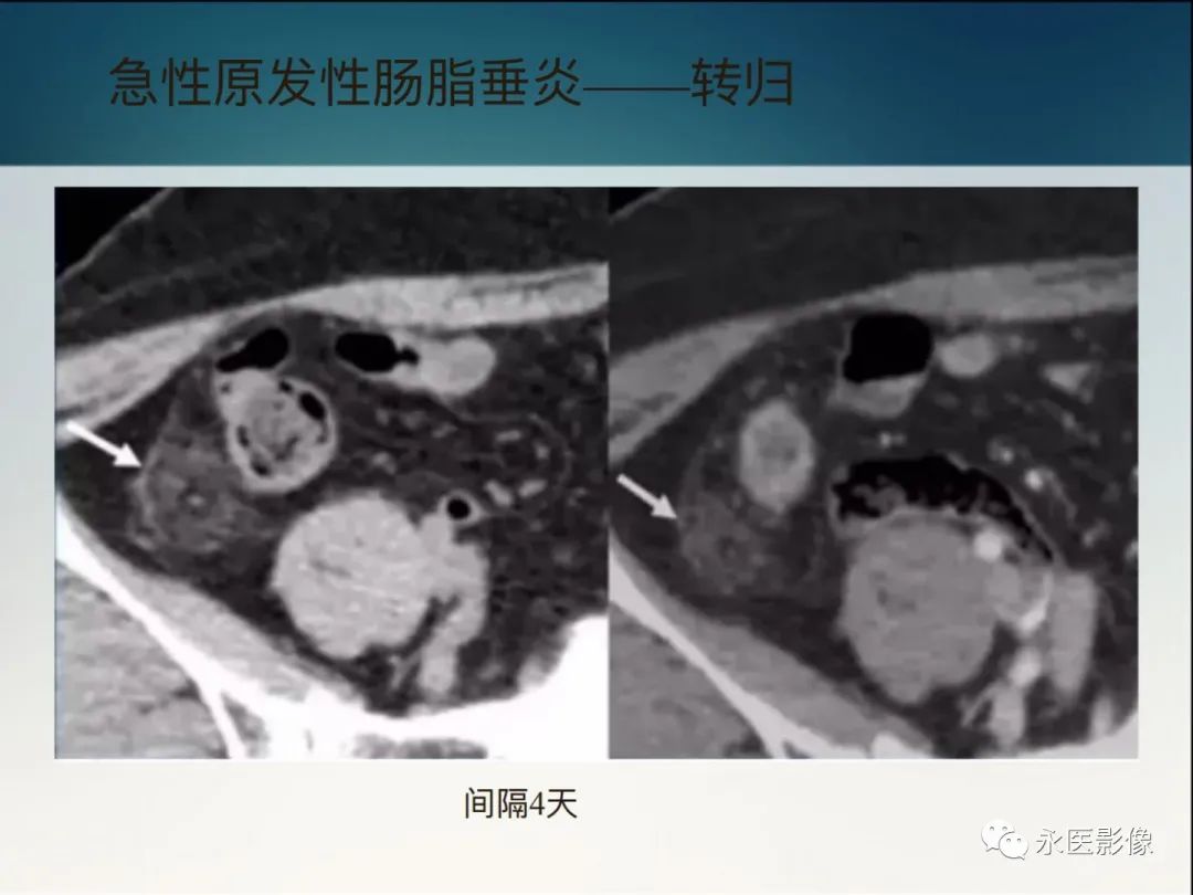 影像PPT - 【PPT】急性原发性肠脂垂炎的CT诊断及鉴别诊断-20