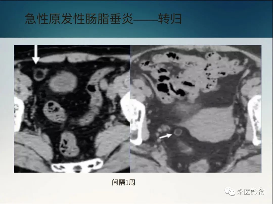 影像PPT - 【PPT】急性原发性肠脂垂炎的CT诊断及鉴别诊断-21