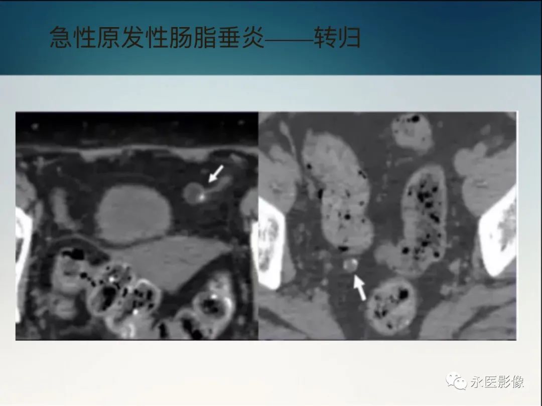 影像PPT - 【PPT】急性原发性肠脂垂炎的CT诊断及鉴别诊断-22
