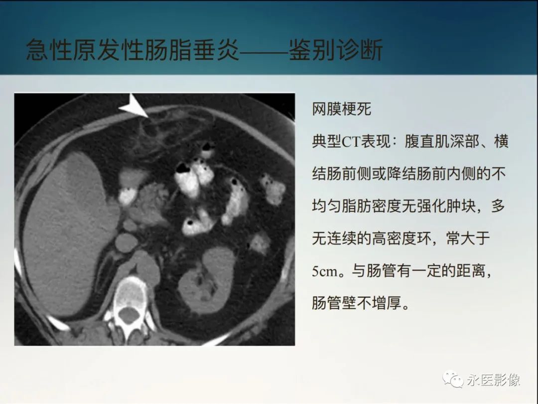 影像PPT - 【PPT】急性原发性肠脂垂炎的CT诊断及鉴别诊断-24