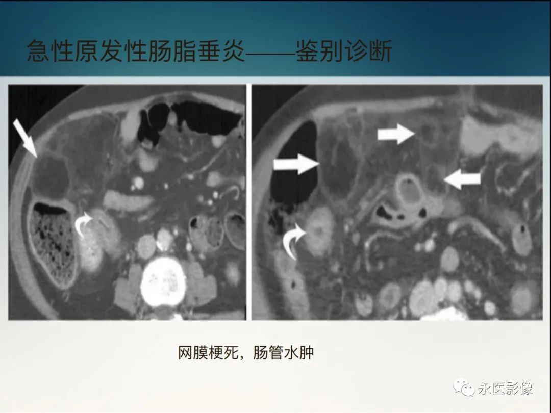 影像PPT - 【PPT】急性原发性肠脂垂炎的CT诊断及鉴别诊断-25