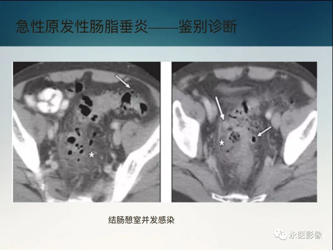 影像PPT - 【PPT】急性原发性肠脂垂炎的CT诊断及鉴别诊断-27