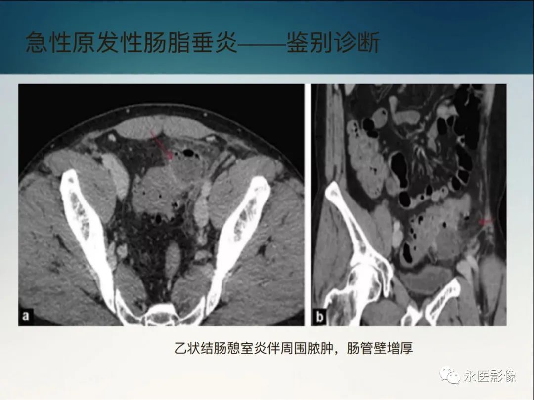 影像PPT - 【PPT】急性原发性肠脂垂炎的CT诊断及鉴别诊断-28