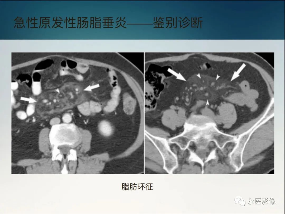 影像PPT - 【PPT】急性原发性肠脂垂炎的CT诊断及鉴别诊断-31