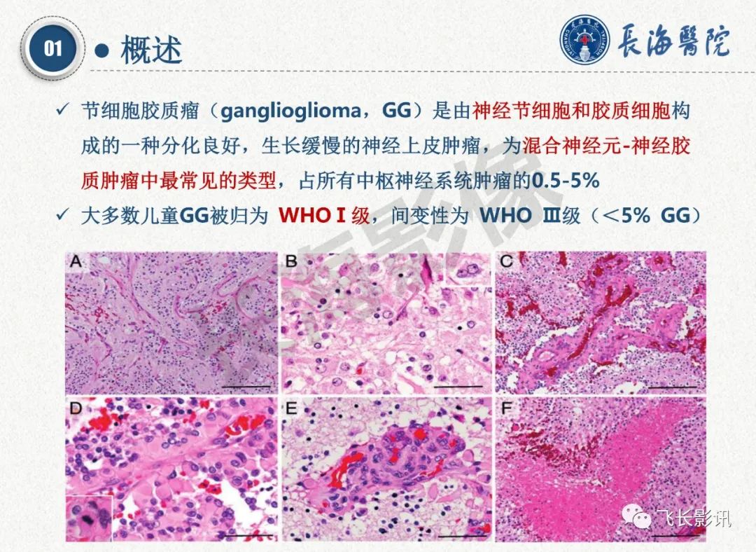 影像PPT - 【PPT】脑节细胞胶质瘤的诊断及鉴别诊断-10