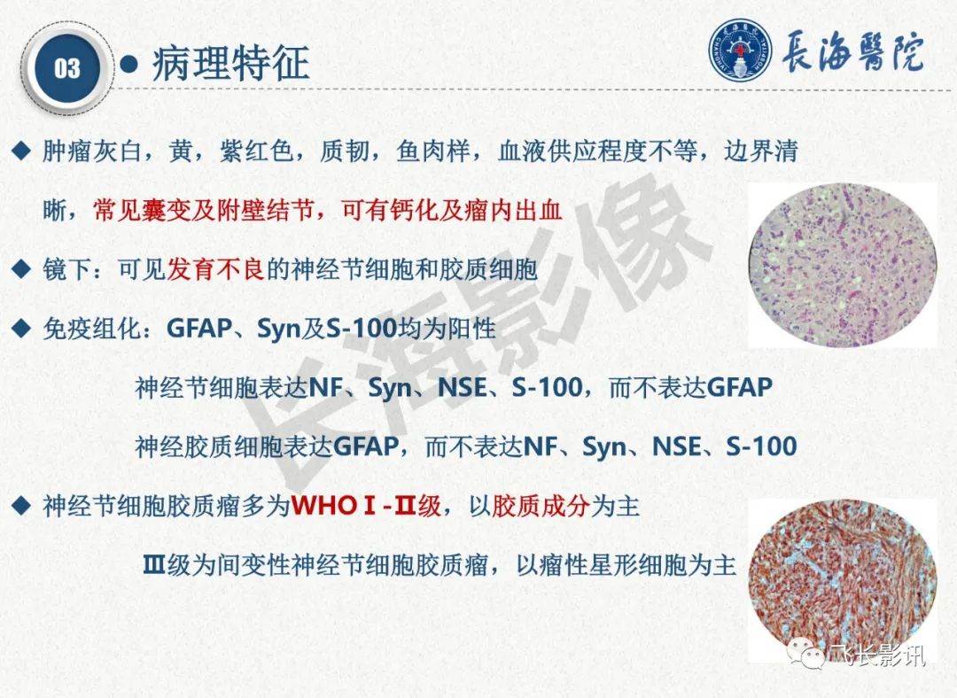 影像PPT - 【PPT】脑节细胞胶质瘤的诊断及鉴别诊断-14