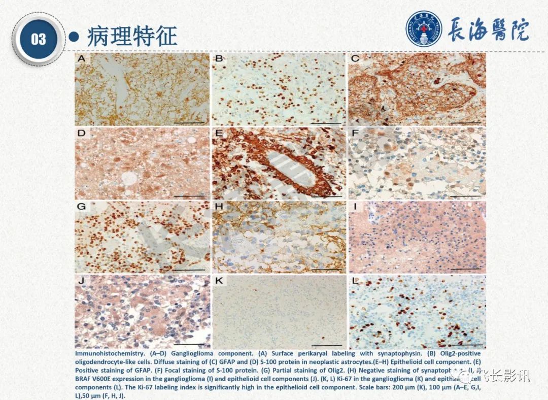 影像PPT - 【PPT】脑节细胞胶质瘤的诊断及鉴别诊断-15