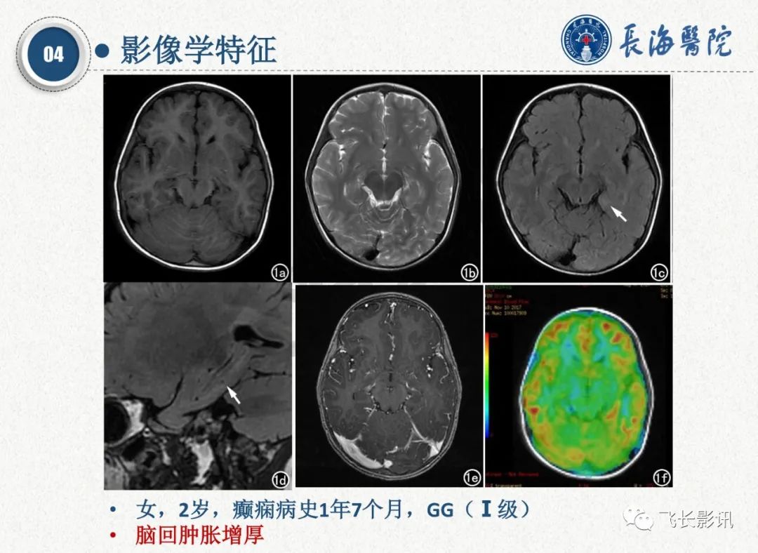 影像PPT - 【PPT】脑节细胞胶质瘤的诊断及鉴别诊断-22