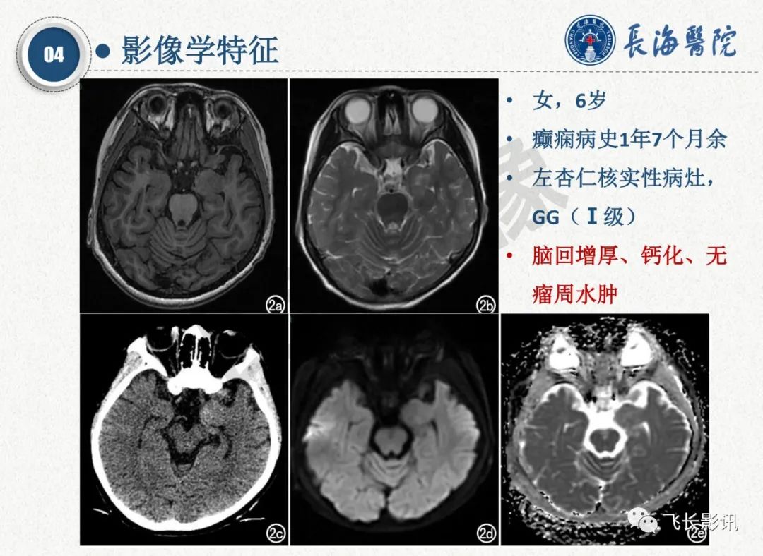 影像PPT - 【PPT】脑节细胞胶质瘤的诊断及鉴别诊断-23