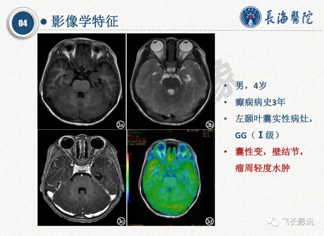 影像PPT - 【PPT】脑节细胞胶质瘤的诊断及鉴别诊断-24