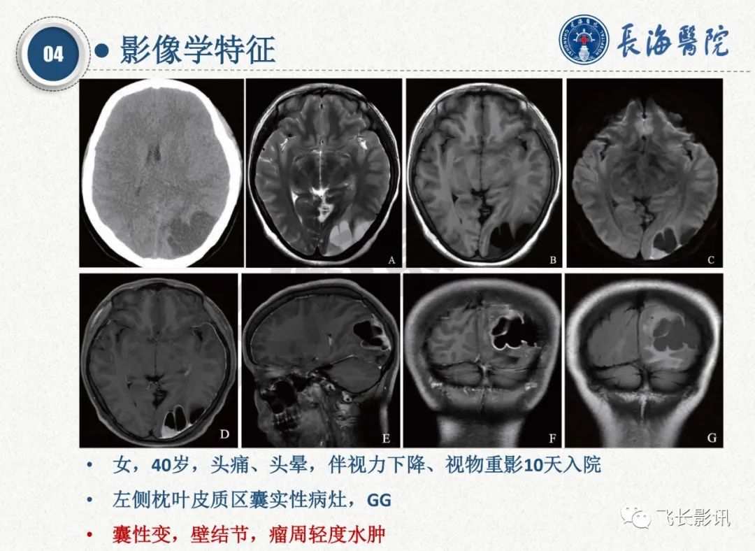 影像PPT - 【PPT】脑节细胞胶质瘤的诊断及鉴别诊断-25