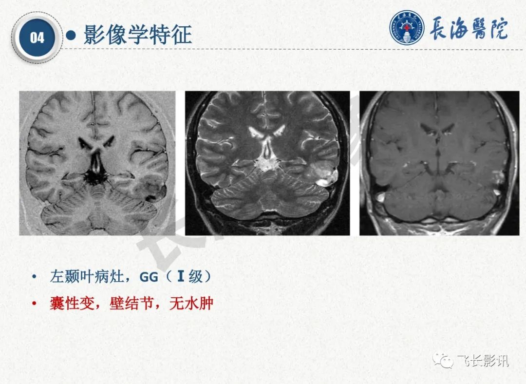 影像PPT - 【PPT】脑节细胞胶质瘤的诊断及鉴别诊断-26