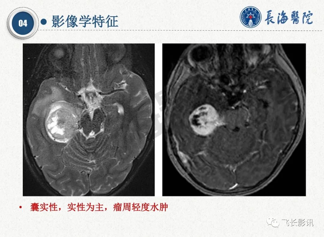 影像PPT - 【PPT】脑节细胞胶质瘤的诊断及鉴别诊断-27