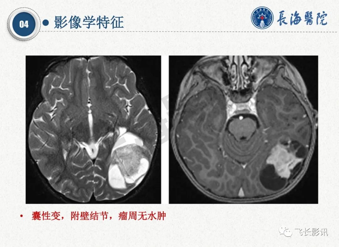 影像PPT - 【PPT】脑节细胞胶质瘤的诊断及鉴别诊断-28