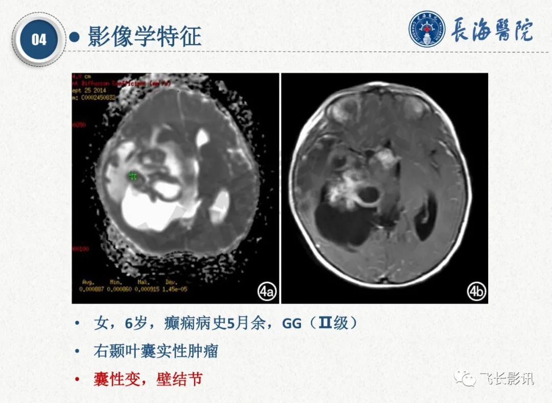 影像PPT - 【PPT】脑节细胞胶质瘤的诊断及鉴别诊断-29