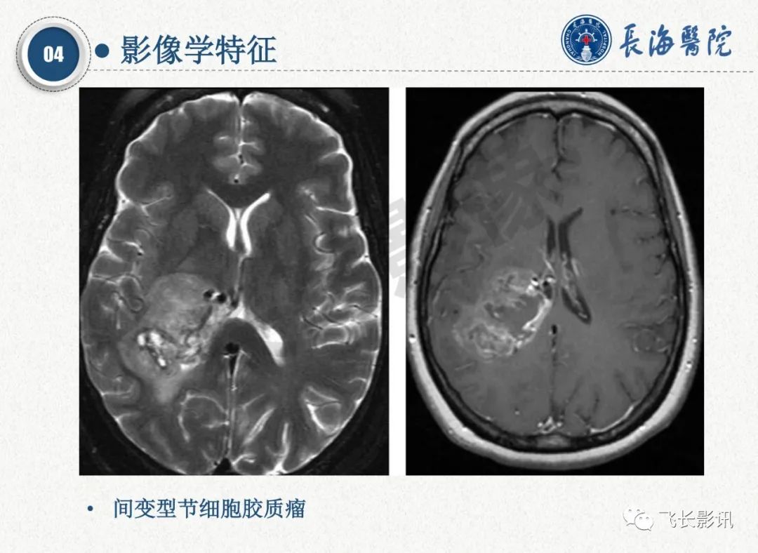 影像PPT - 【PPT】脑节细胞胶质瘤的诊断及鉴别诊断-30