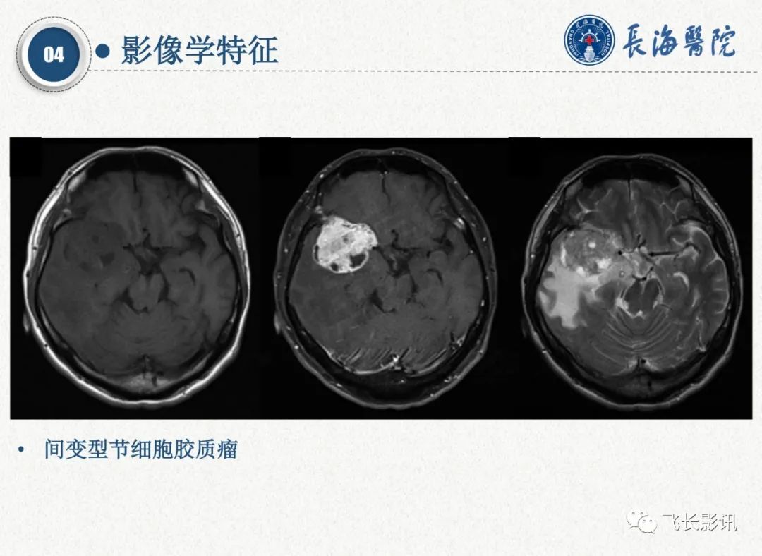影像PPT - 【PPT】脑节细胞胶质瘤的诊断及鉴别诊断-31